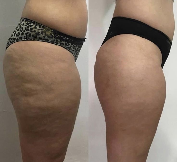 Endosphere before and after