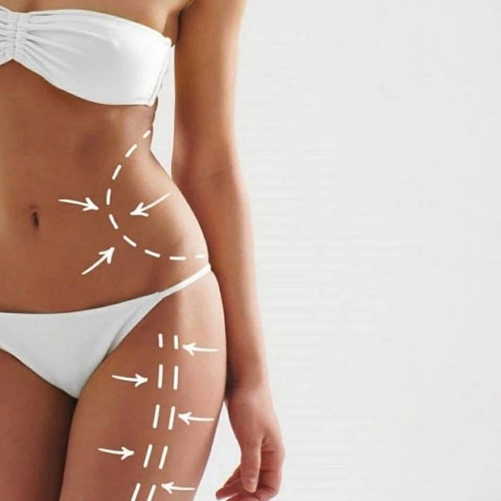 Body sculpting